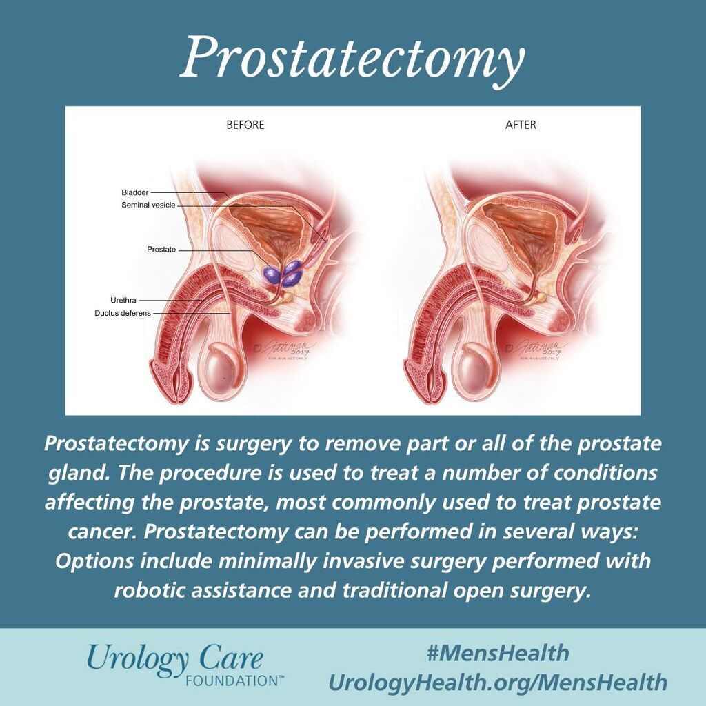 Prostatectomy