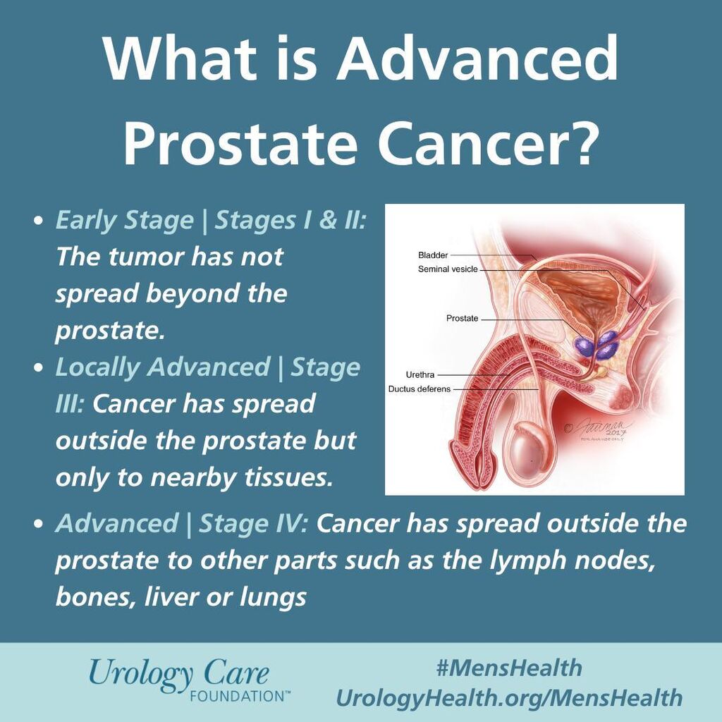 prostate cancer spreads beyond the prostate or returns after treatment, it is often called advanced prostate cancer