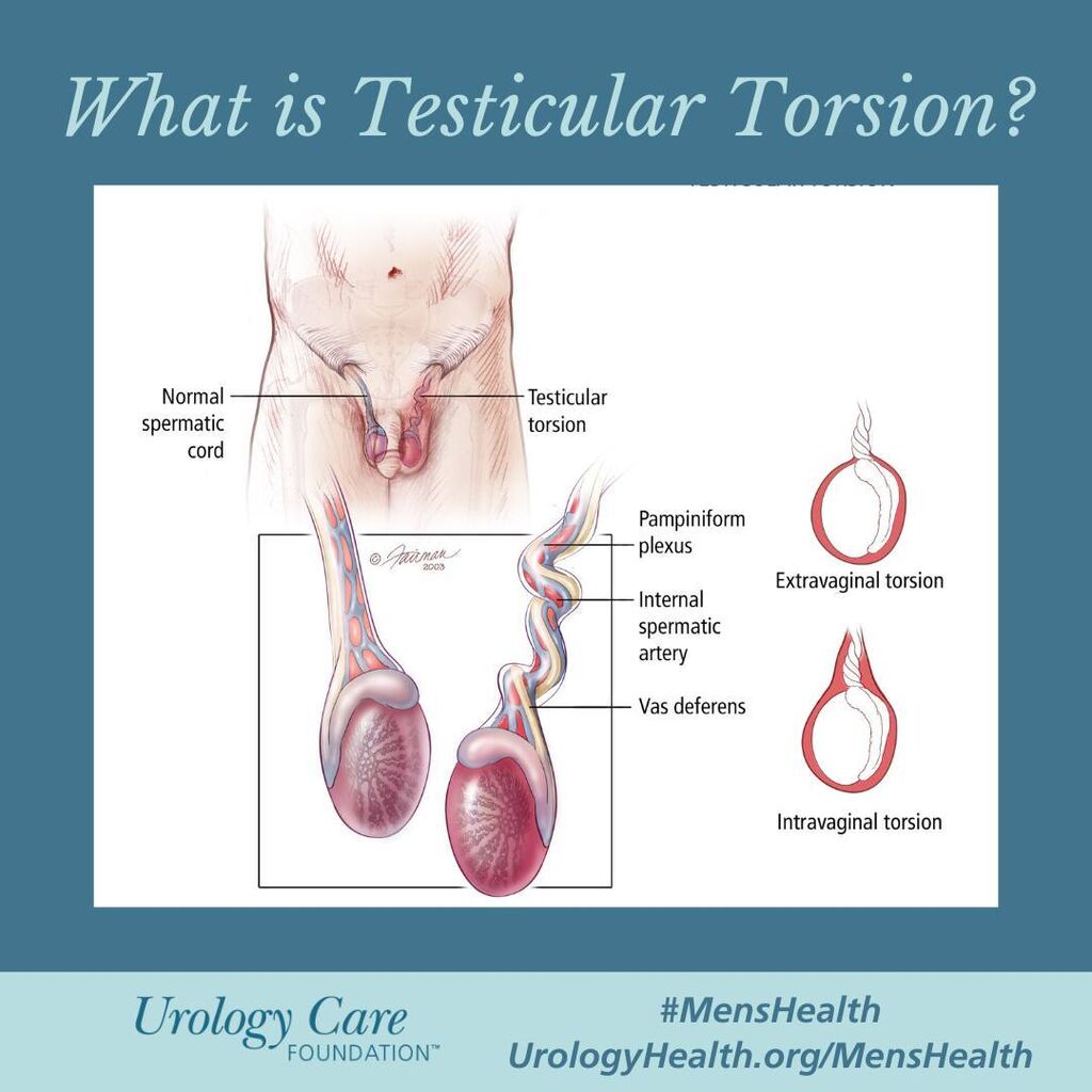 Testicular Torsion
