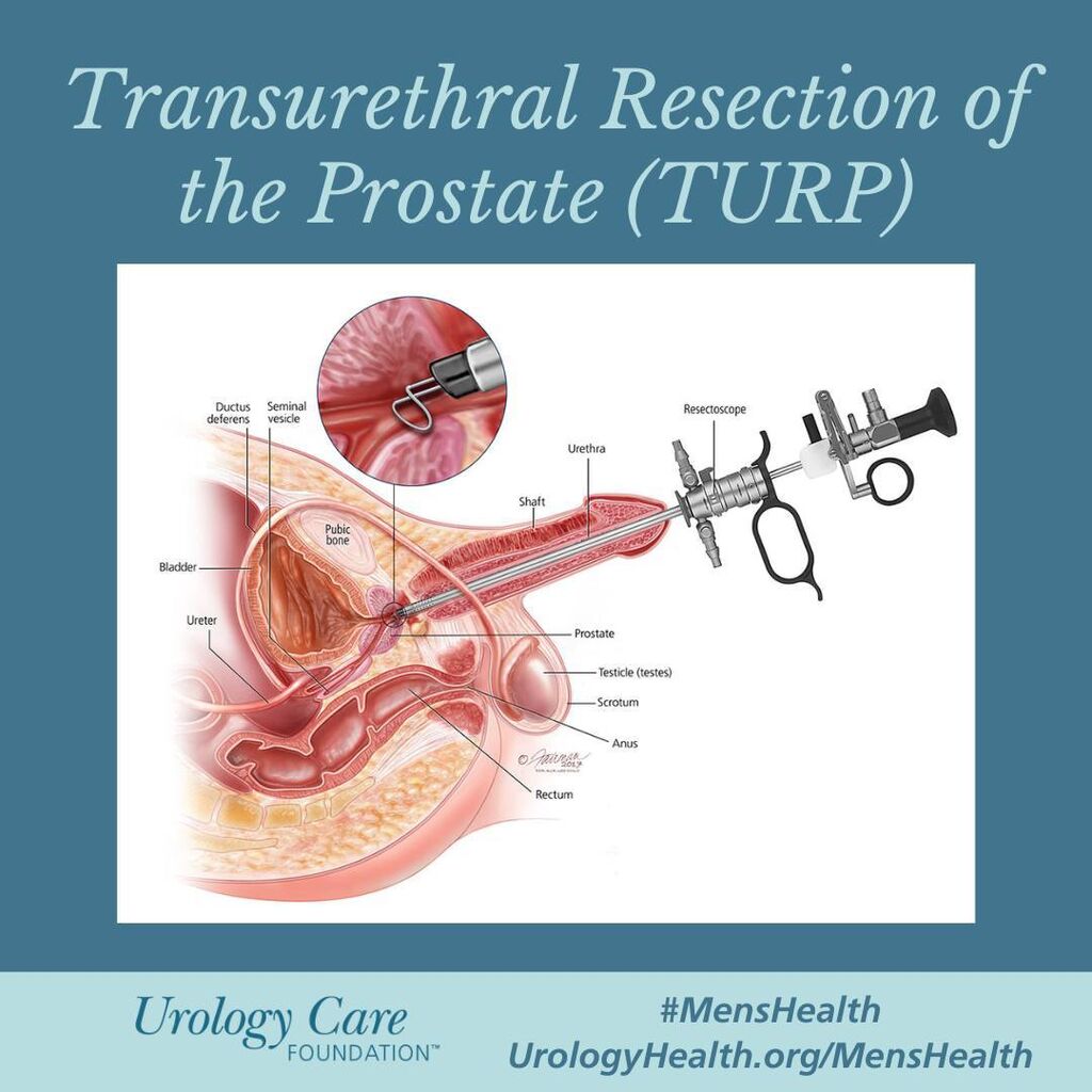 Transurethral Resection of the Prostate is a very common surgery for BPH.