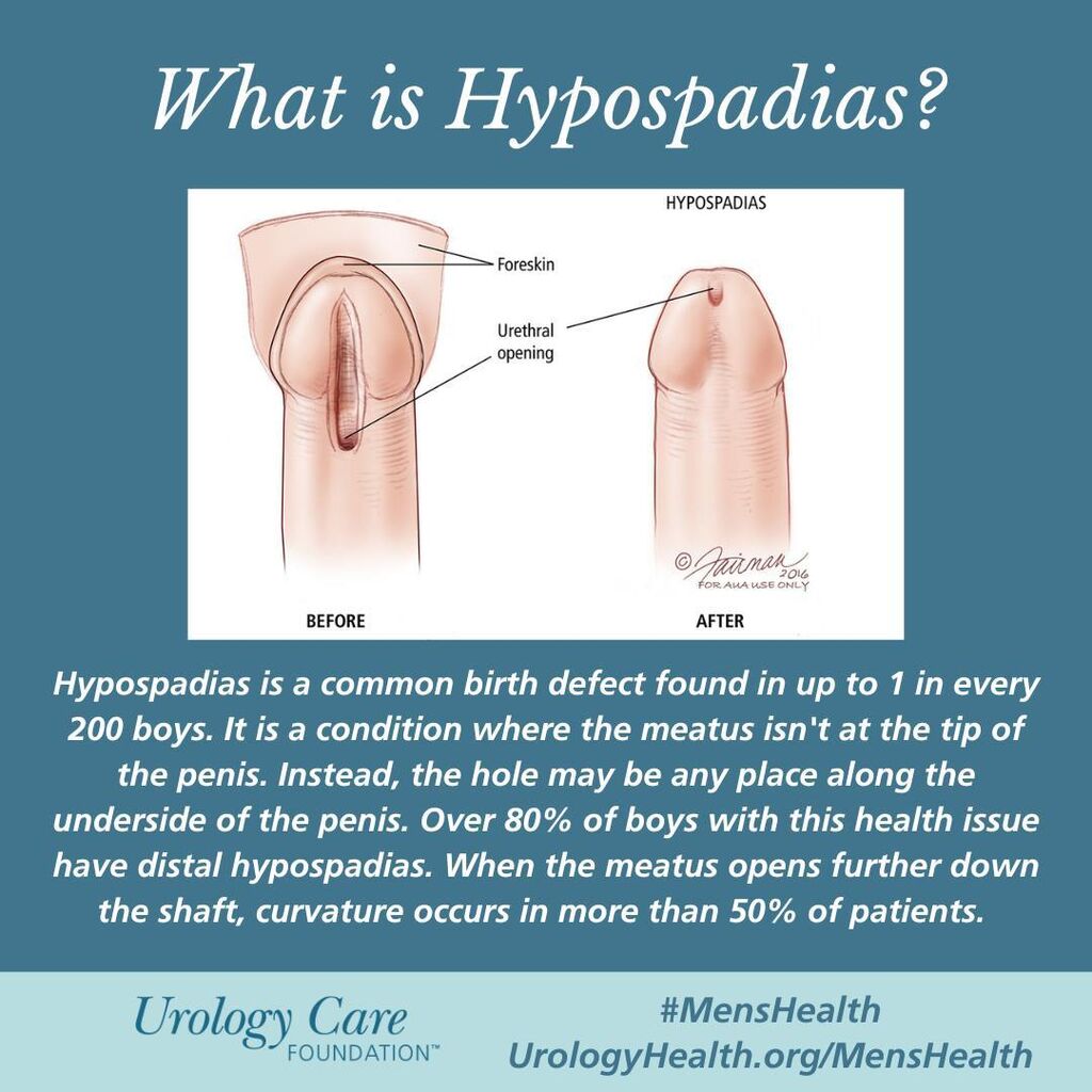 Hypospadias