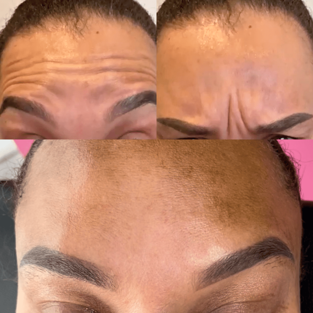 Botulinum Toxin Information