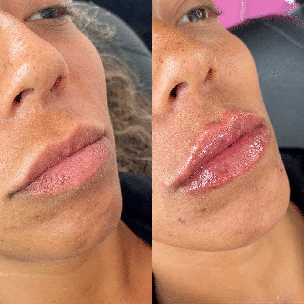 Dermal Fillers Information