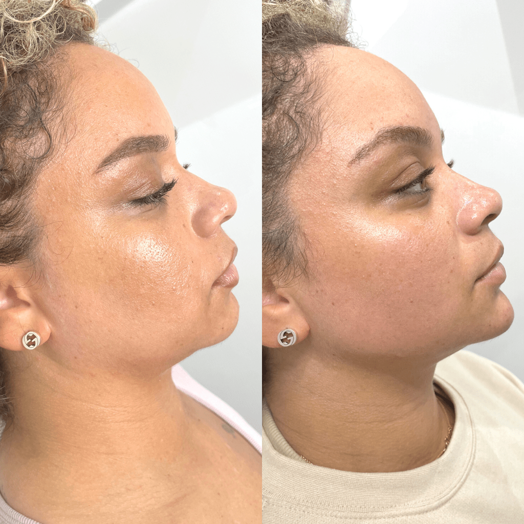 Skin Boosters Information
