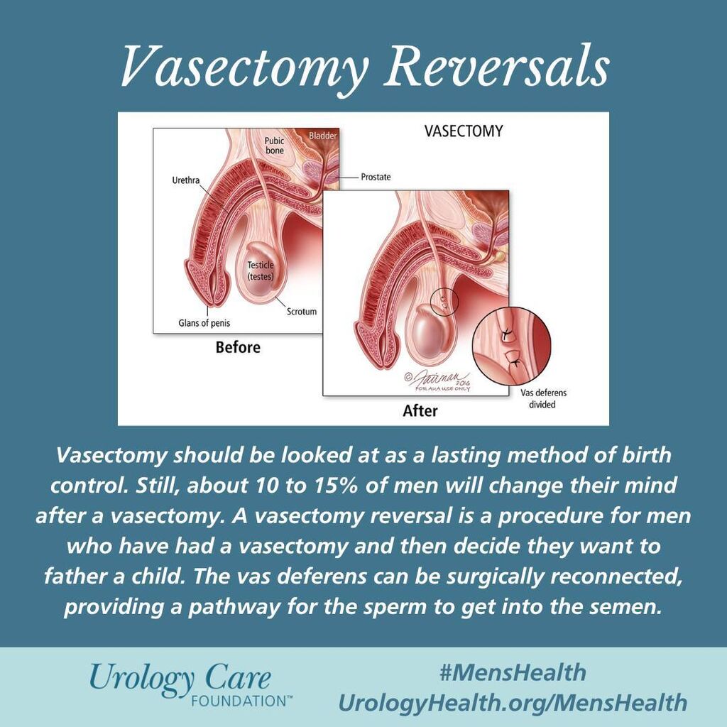 A #vasectomy should be looked at as a lasting method of #BirthControl. Still, about 10 to 15% of men will change their mind. The vas deferens can be surgically reconnected.