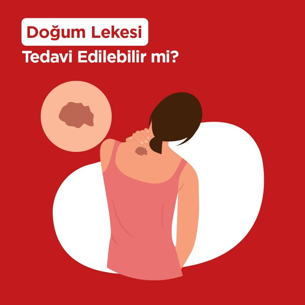 Doğum Lekesi