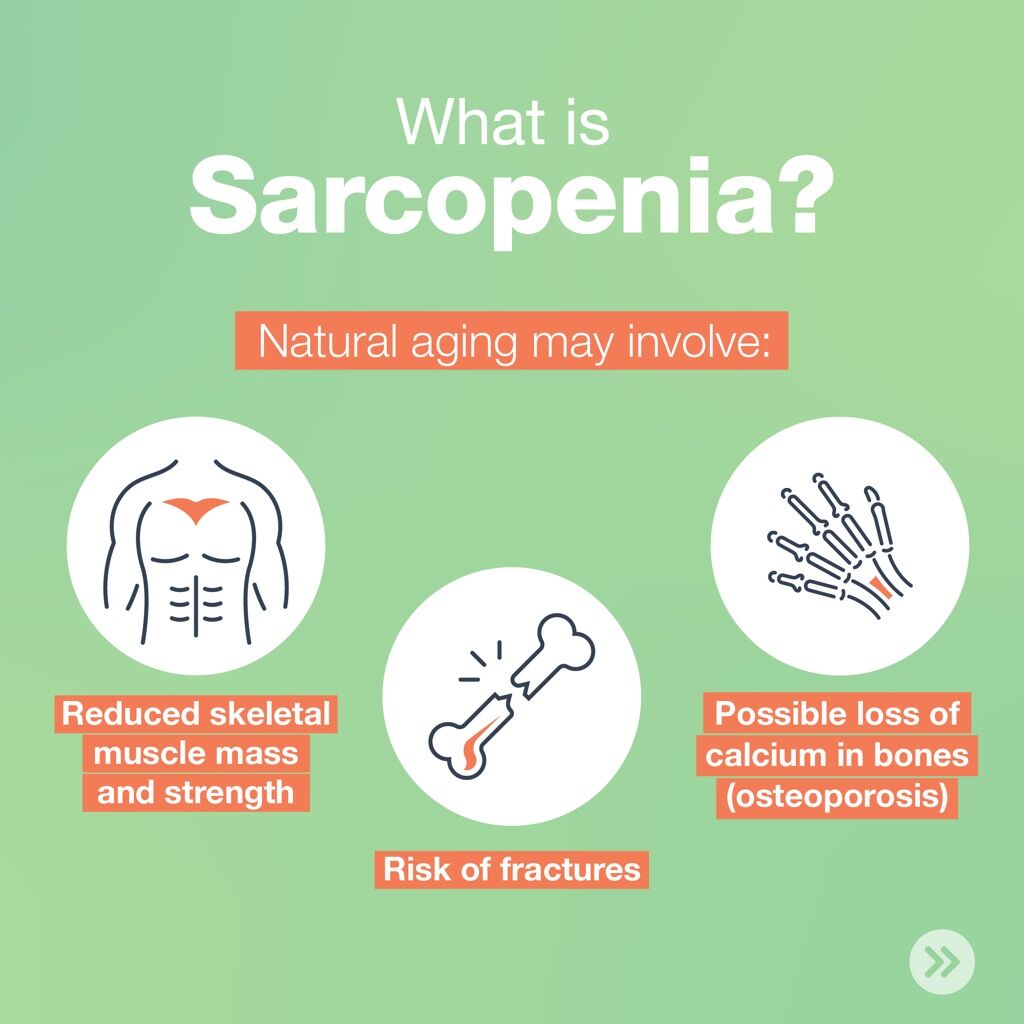 How to Prevent Sarcopenia: Protein Intake and Active Lifestyle Are Key